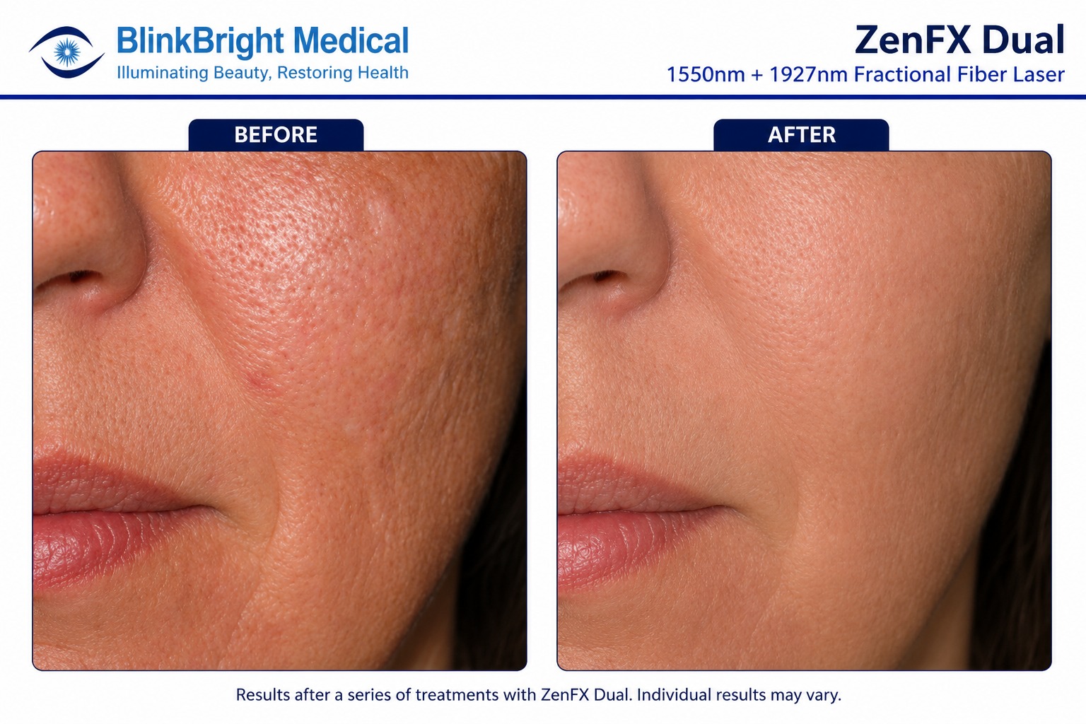 Active Inflammatory Acne Clearout