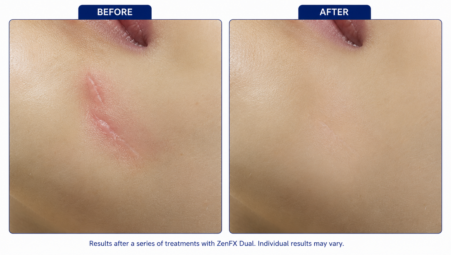 Active Inflammatory Acne Clearout