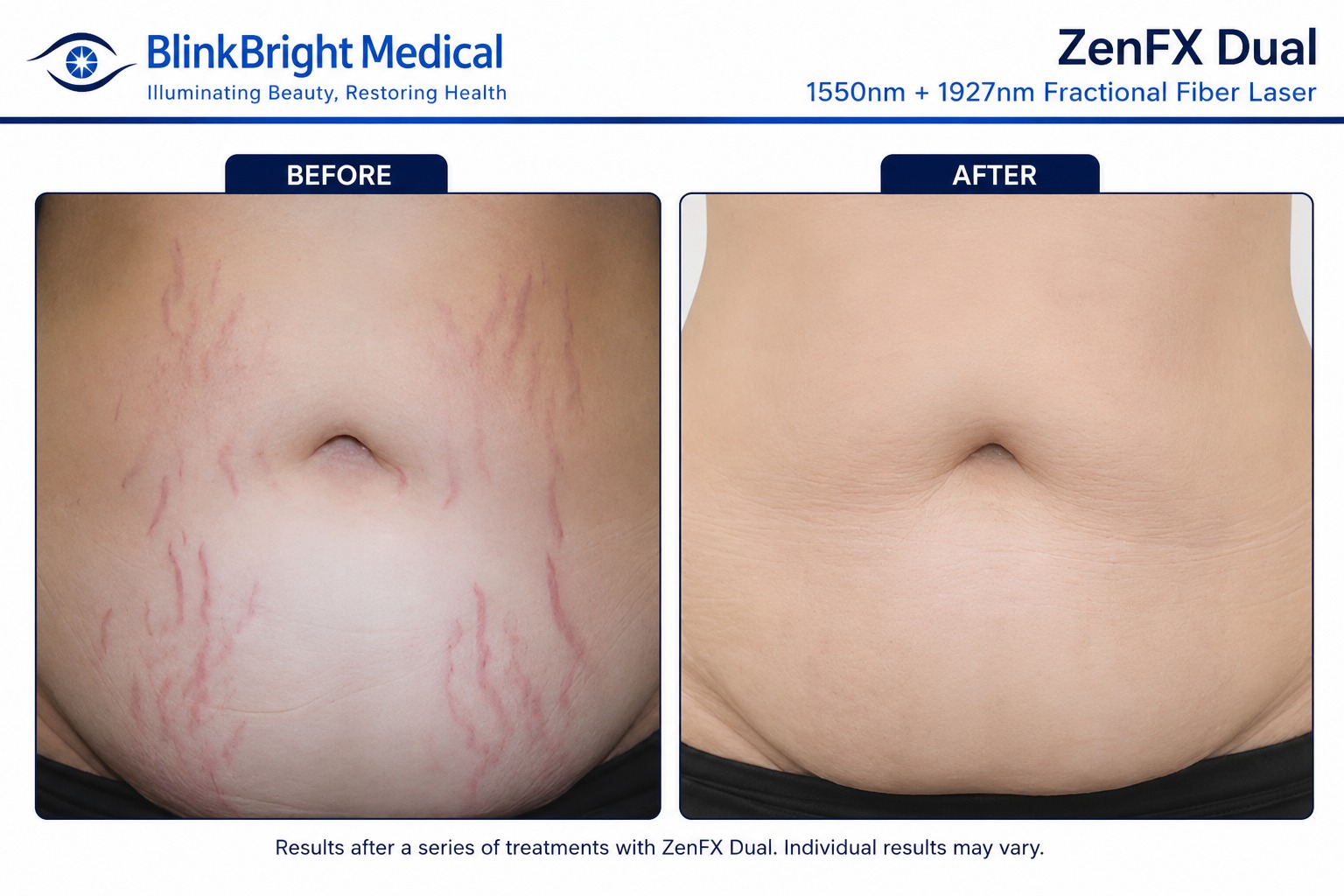 Severe Deep Acne Scar Remodeling