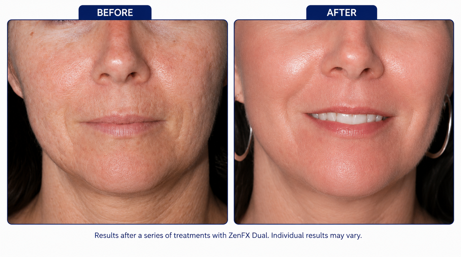 Severe Deep Acne Scar Remodeling