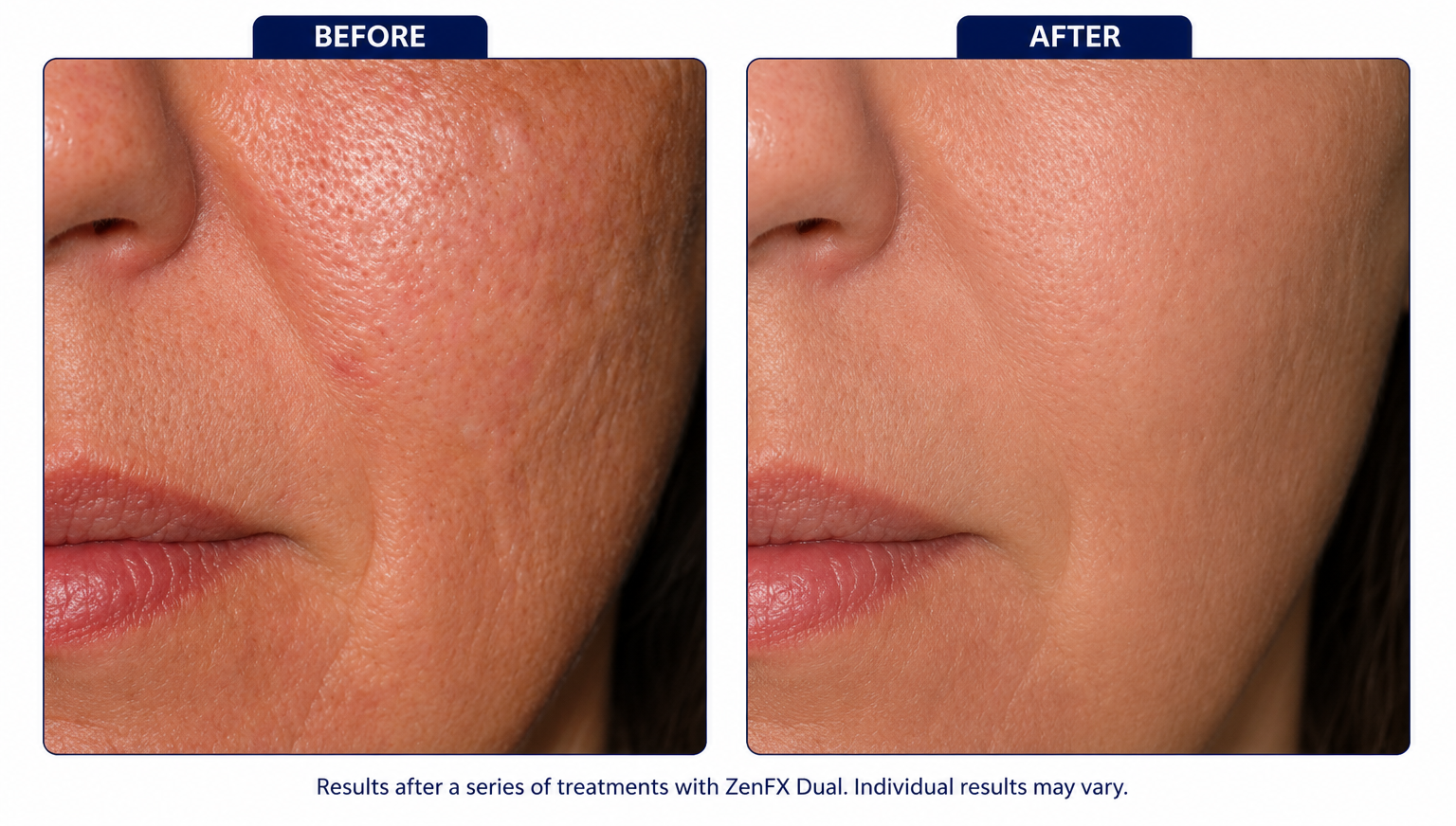 Melasma & Pigmentation Tone Clarification